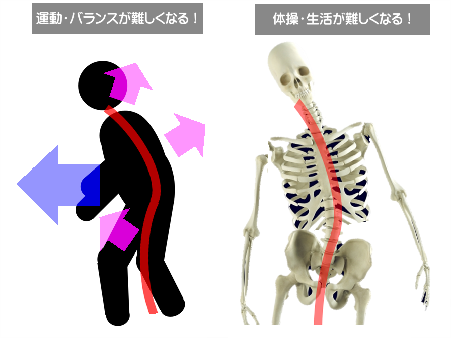 代償から歪みが進行し筋トレや体操ができ成立しなくなり、リハビリの成果が上がらなくなる