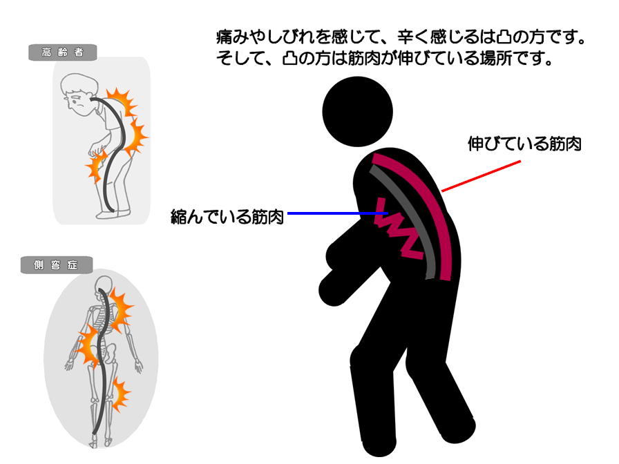高齢者や障害者の筋力が少ない人は、マッサージの間違いによって代償を進め体の歪みを強めやすい